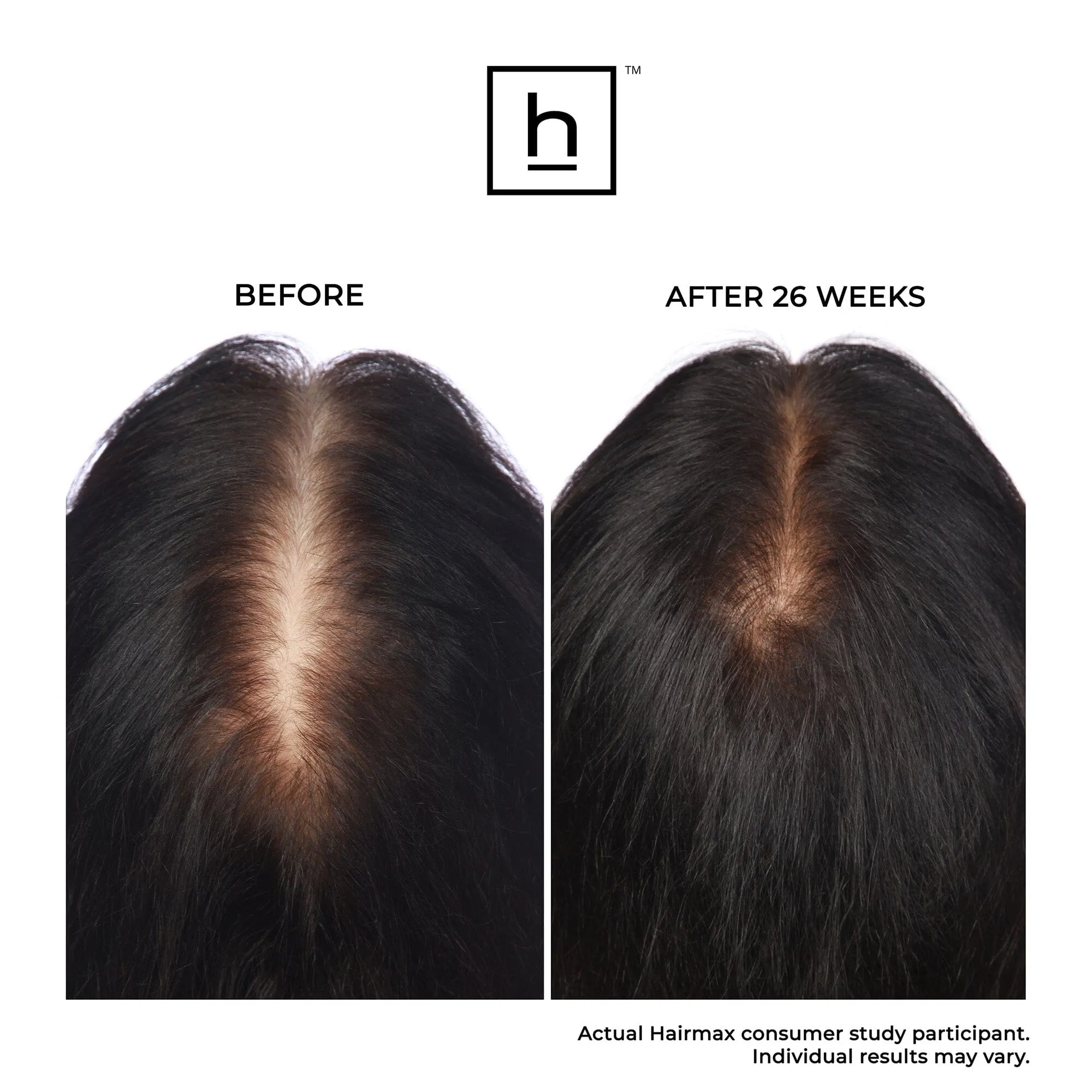 Hairmax Laser Band 41 ComfortFlex Hair Growth Device