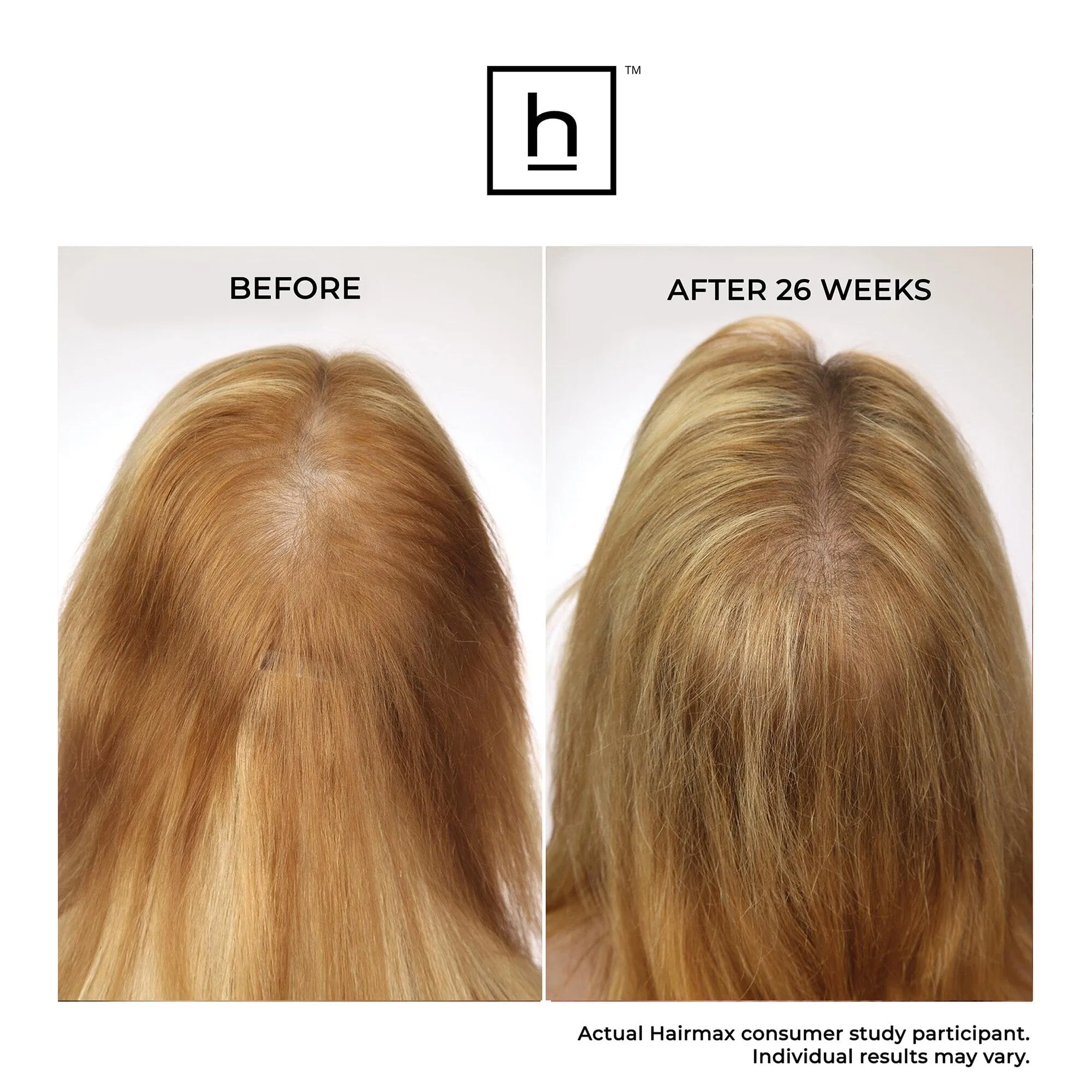 Hairmax Laser Band 41 ComfortFlex Hair Growth Device