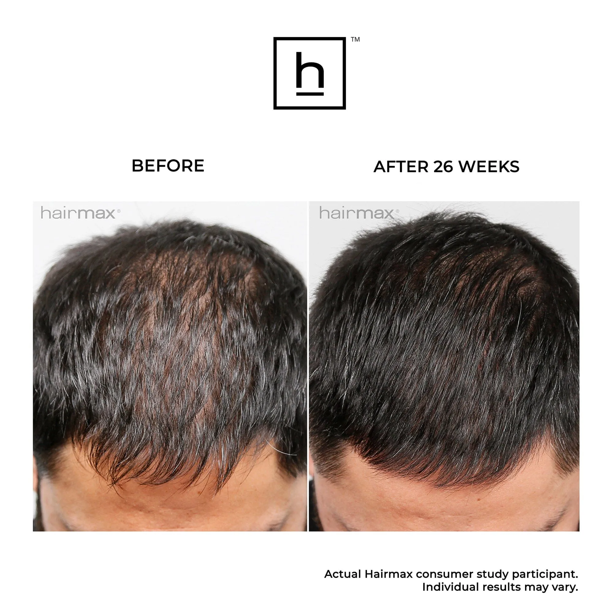 Hairmax Laser Band 41 ComfortFlex Hair Growth Device
